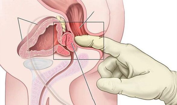 Prostate rectal examination